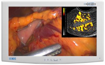 NDS厂家供应 NDS监视器/STORZ监视器 内窥镜专用监视器